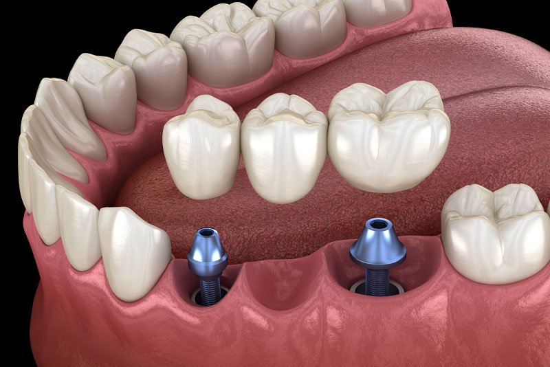 dental implant crown model