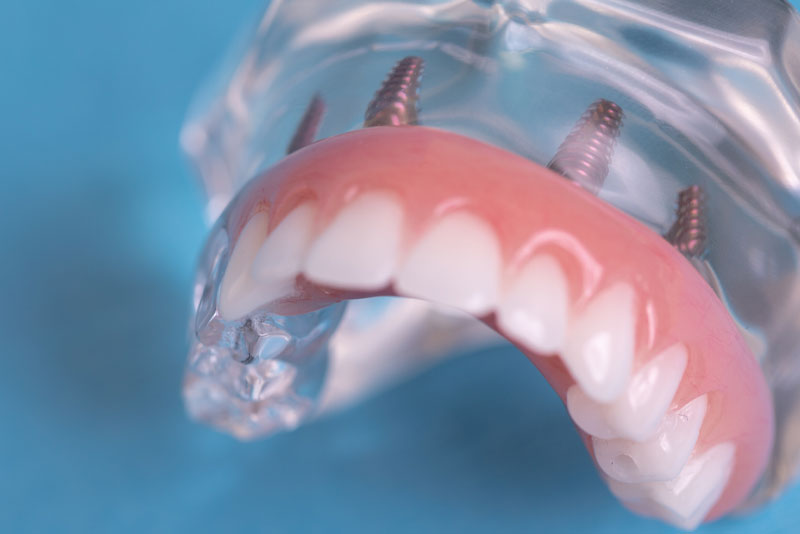 a full mouth dental implant model a skilled doctor can use to show patients how it gives them a more secure smile than traditional dentures.