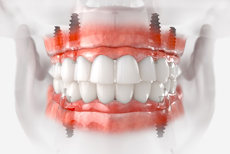 a digital model of full mouth dental implants being placed.
