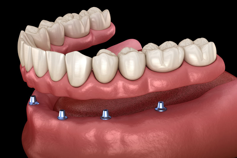 a graphic image of an implant supported denture model. the prosthesis is hovering over where the dental implants are displayed in the jawbone.