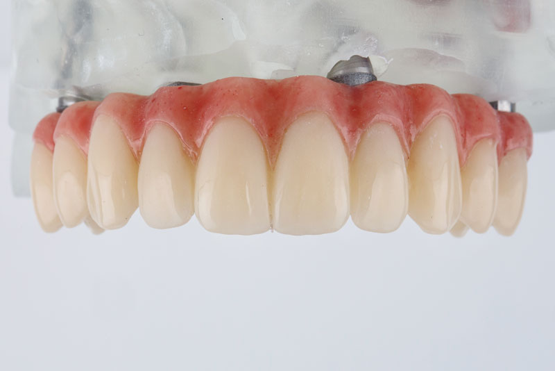 an all on x full mouth dental implant prosthesis model.