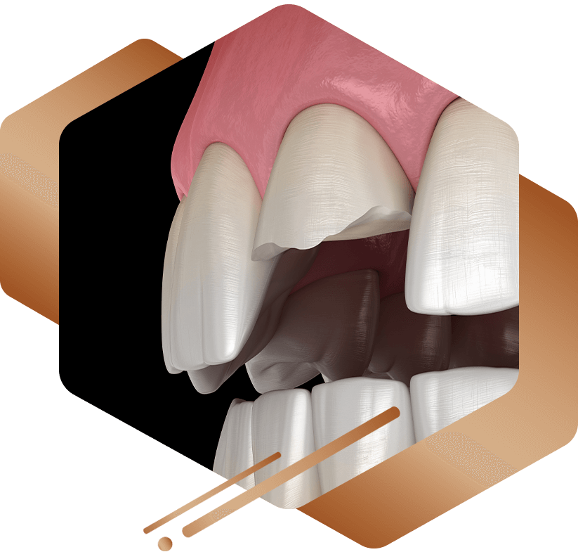 cracked tooth 3d