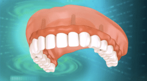 Dentist consulting a patient about denture implants, dentures, crowns, and bridges in a modern dental office