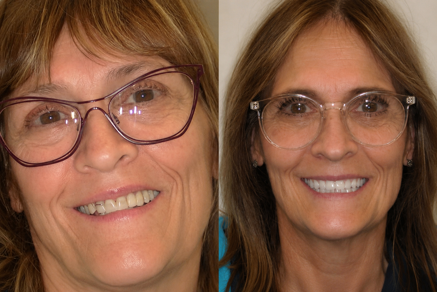 holly-beforeafter